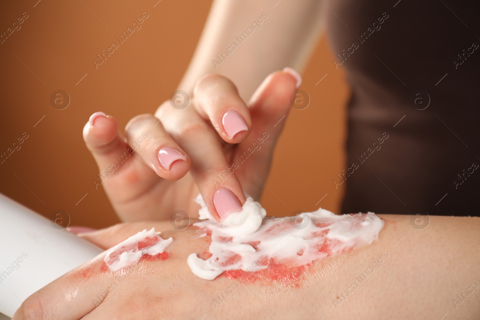 Woman applying healing cream onto burned hand on brown background, closeup Photo of Woman applying healing cream onto burned hand on brown background, closeup