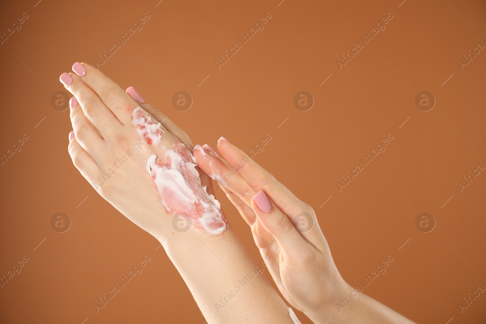Woman applying healing cream onto burned hand on brown background, closeup. Space for text Photo of Woman applying healing cream onto burned hand on brown background, closeup. Space for text