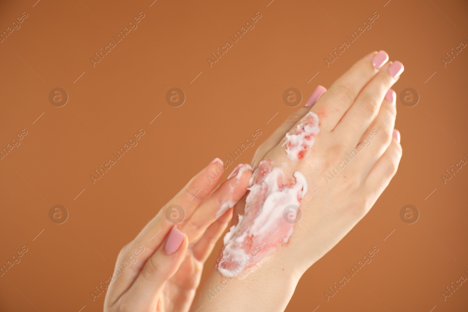 Woman applying healing cream onto burned hand on brown background, closeup. Space for text Photo of Woman applying healing cream onto burned hand on brown background, closeup. Space for text