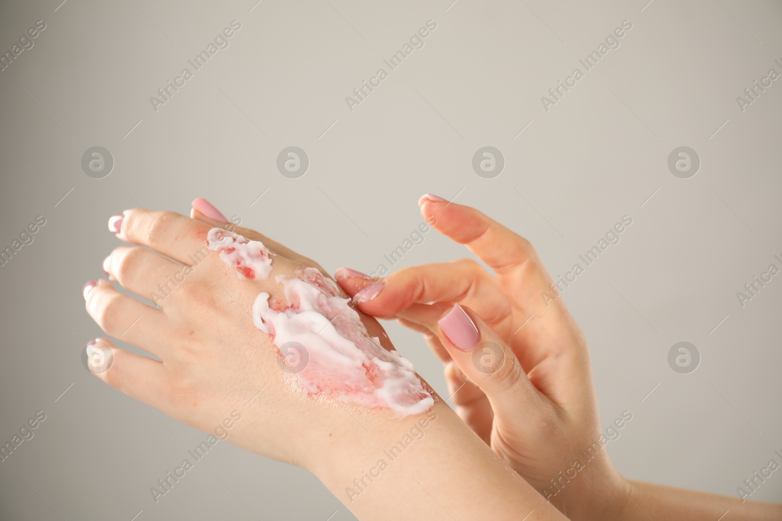 Woman applying healing cream onto burned hand on light grey background, closeup. Space for text Photo of Woman applying healing cream onto burned hand on light grey background, closeup. Space for text