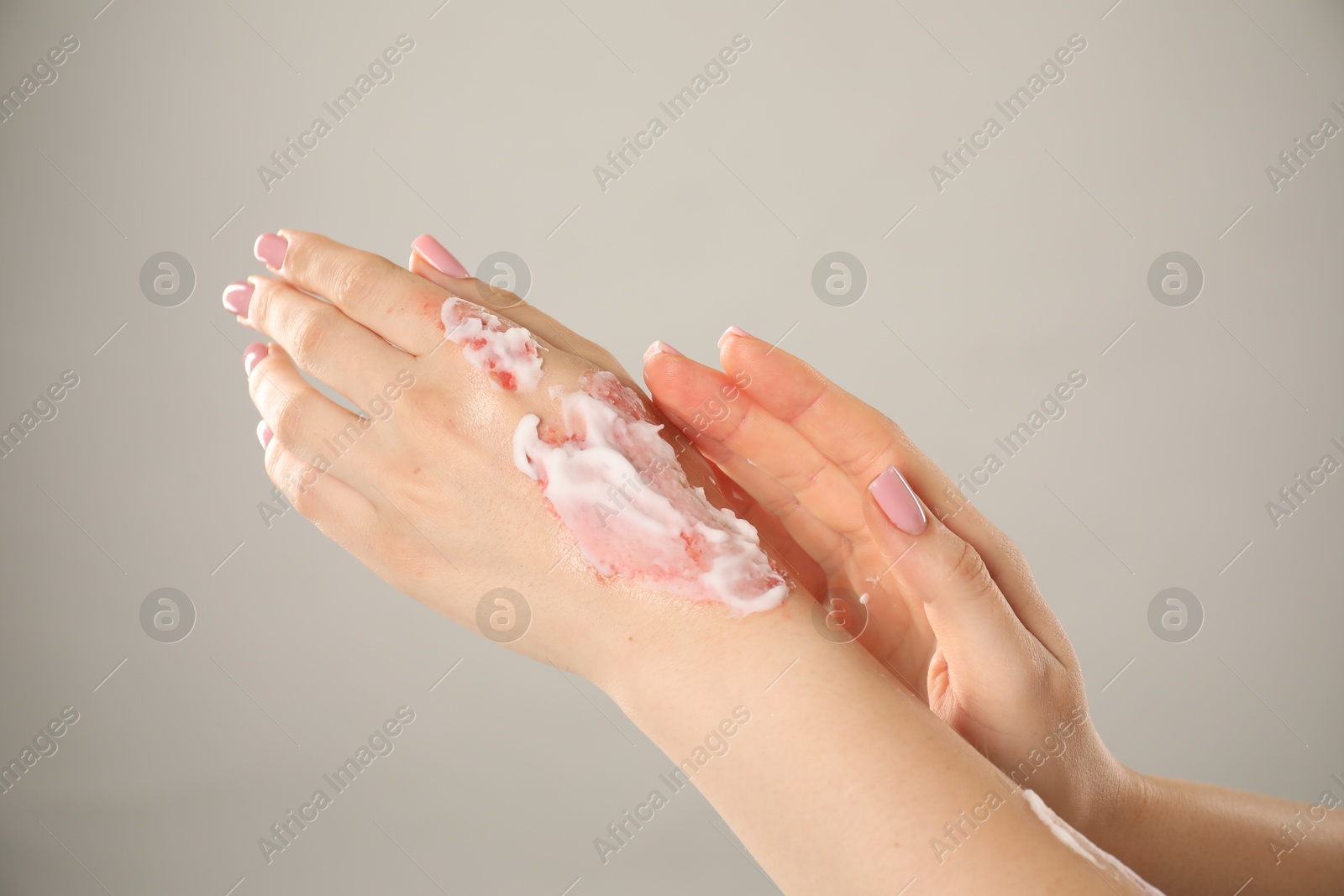 Photo of Woman applying healing cream onto burned hand on light grey background, closeup. Space for text