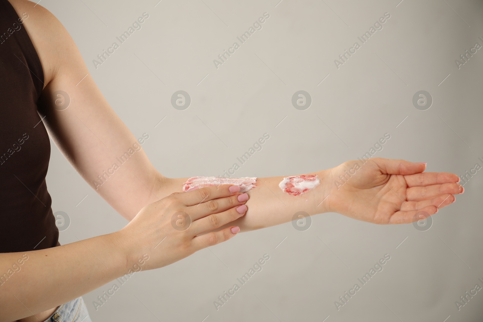 Woman applying healing cream onto burned hand on light grey background, closeup. Space for text Photo of Woman applying healing cream onto burned hand on light grey background, closeup. Space for text
