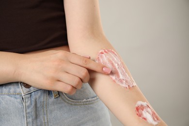 Photo of Woman applying healing cream onto burned hand on light grey background, closeup
