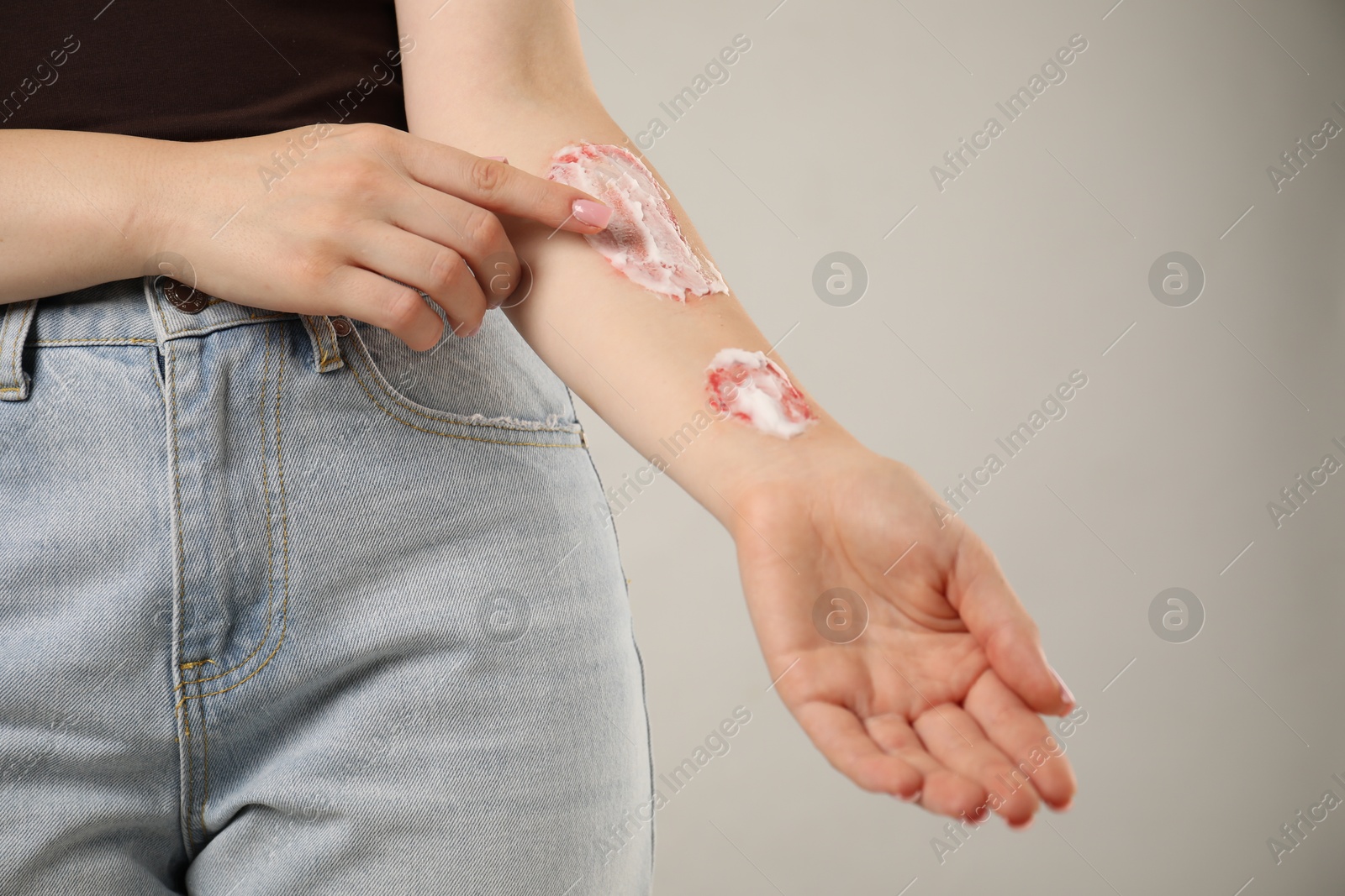 Woman applying healing cream onto burned hand on light grey background, closeup Photo of Woman applying healing cream onto burned hand on light grey background, closeup