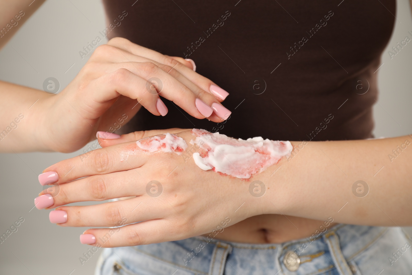 Woman applying healing cream onto burned hand on light grey background, closeup Photo of Woman applying healing cream onto burned hand on light grey background, closeup