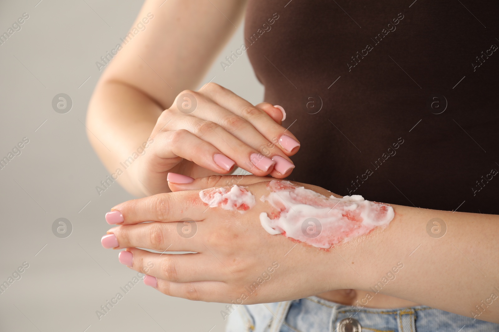 Photo of Woman applying healing cream onto burned hand on light grey background, closeup