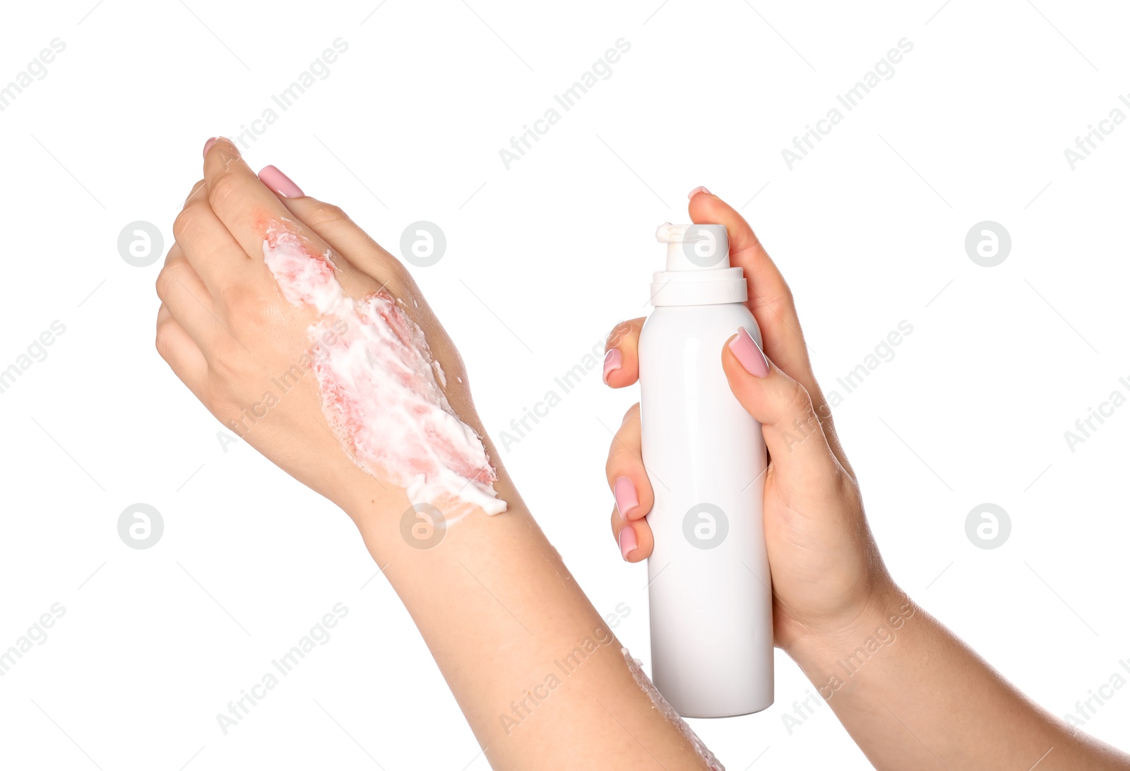 Woman applying healing cream onto burned hand on white background, closeup Photo of Woman applying healing cream onto burned hand on white background, closeup