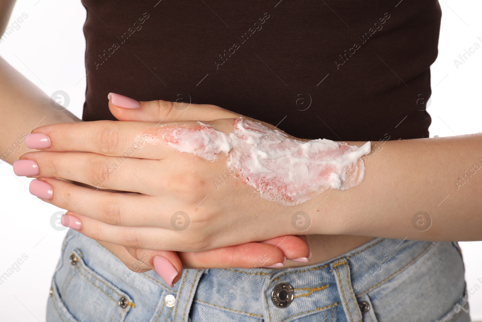 Woman applying healing cream onto burned hand on white background, closeup Photo of Woman applying healing cream onto burned hand on white background, closeup