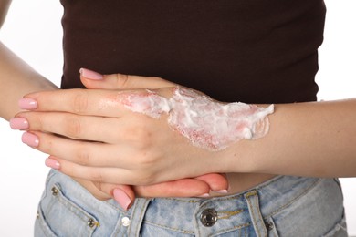 Photo of Woman applying healing cream onto burned hand on white background, closeup
