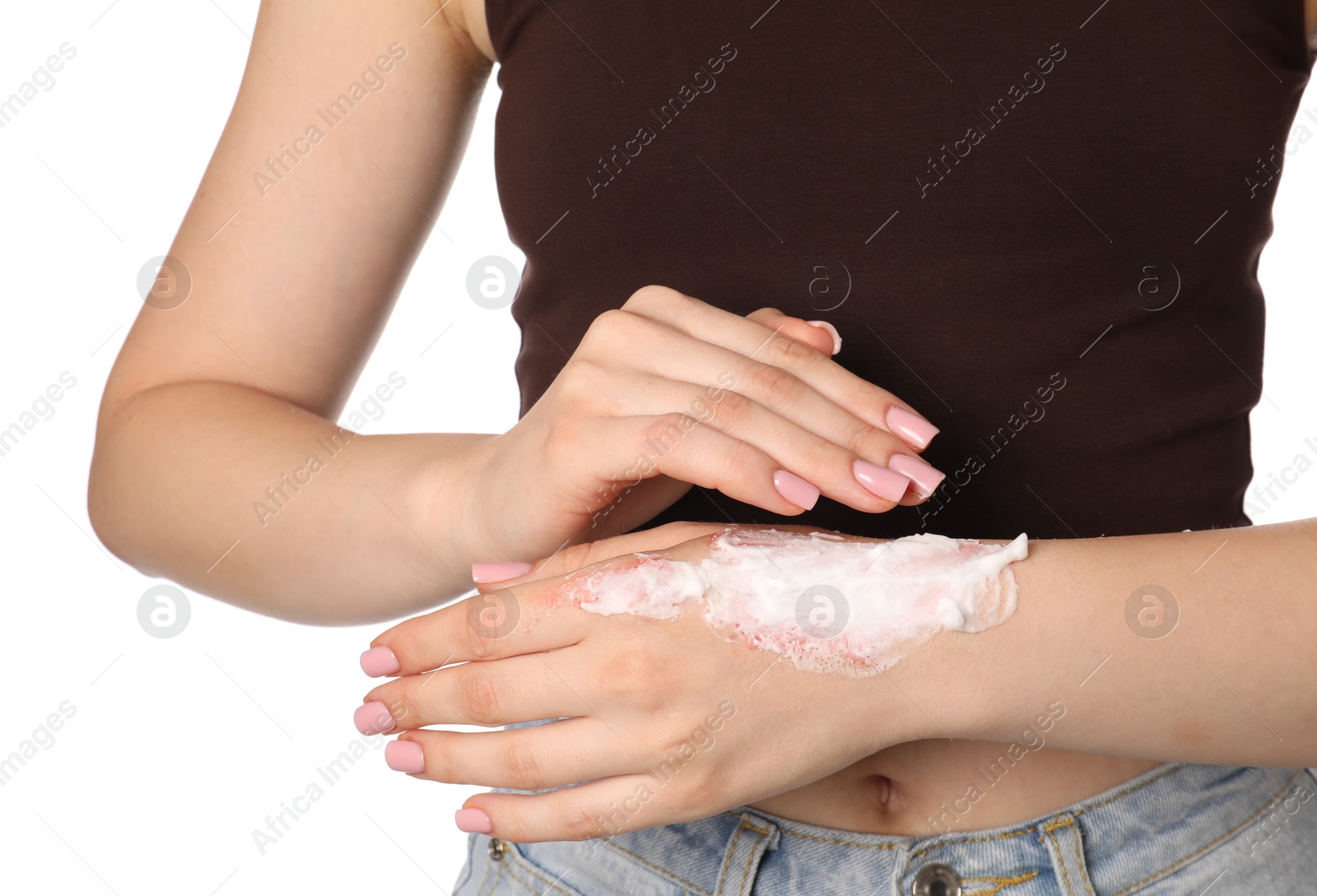 Woman applying healing cream onto burned hand on white background, closeup Photo of Woman applying healing cream onto burned hand on white background, closeup