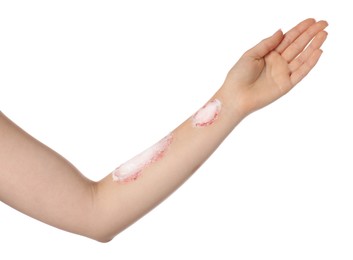 Photo of Woman applying healing cream onto burned hand on white background, closeup