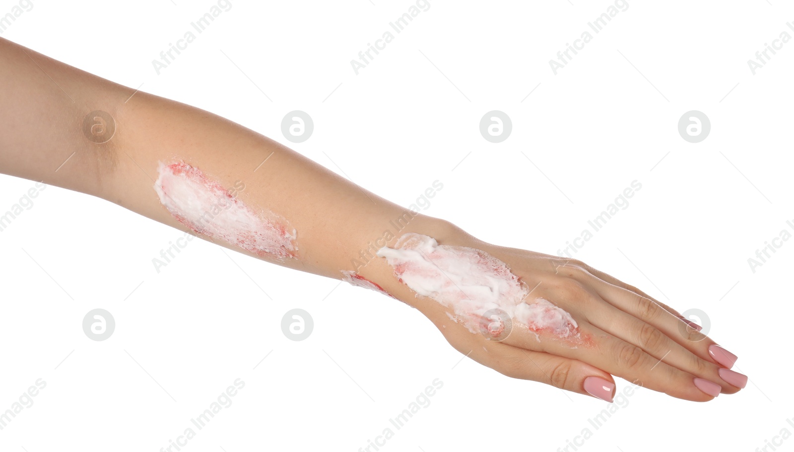 Woman applying healing cream onto burned hand on white background, closeup Photo of Woman applying healing cream onto burned hand on white background, closeup
