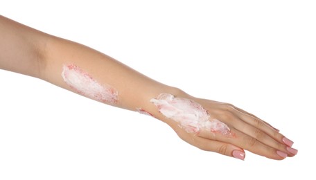 Photo of Woman applying healing cream onto burned hand on white background, closeup