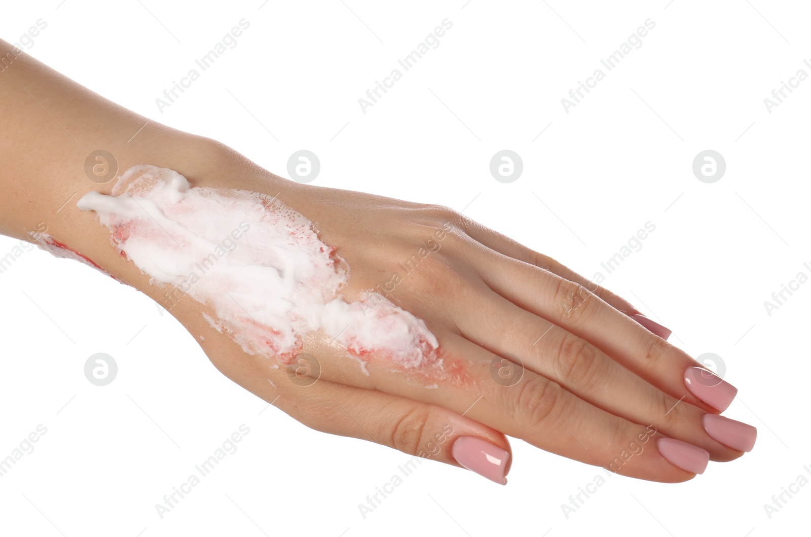 Woman applying healing cream onto burned hand on white background, closeup Photo of Woman applying healing cream onto burned hand on white background, closeup