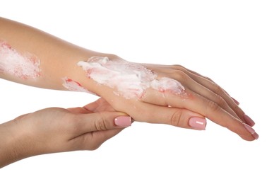 Photo of Woman applying healing cream onto burned hand on white background, closeup
