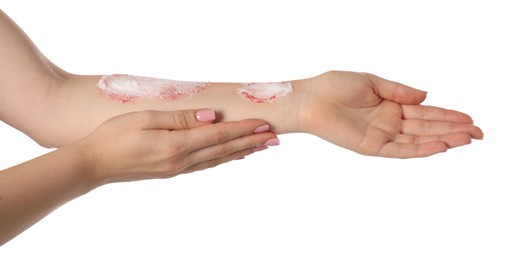 Photo of Woman applying healing cream onto burned hand on white background, closeup