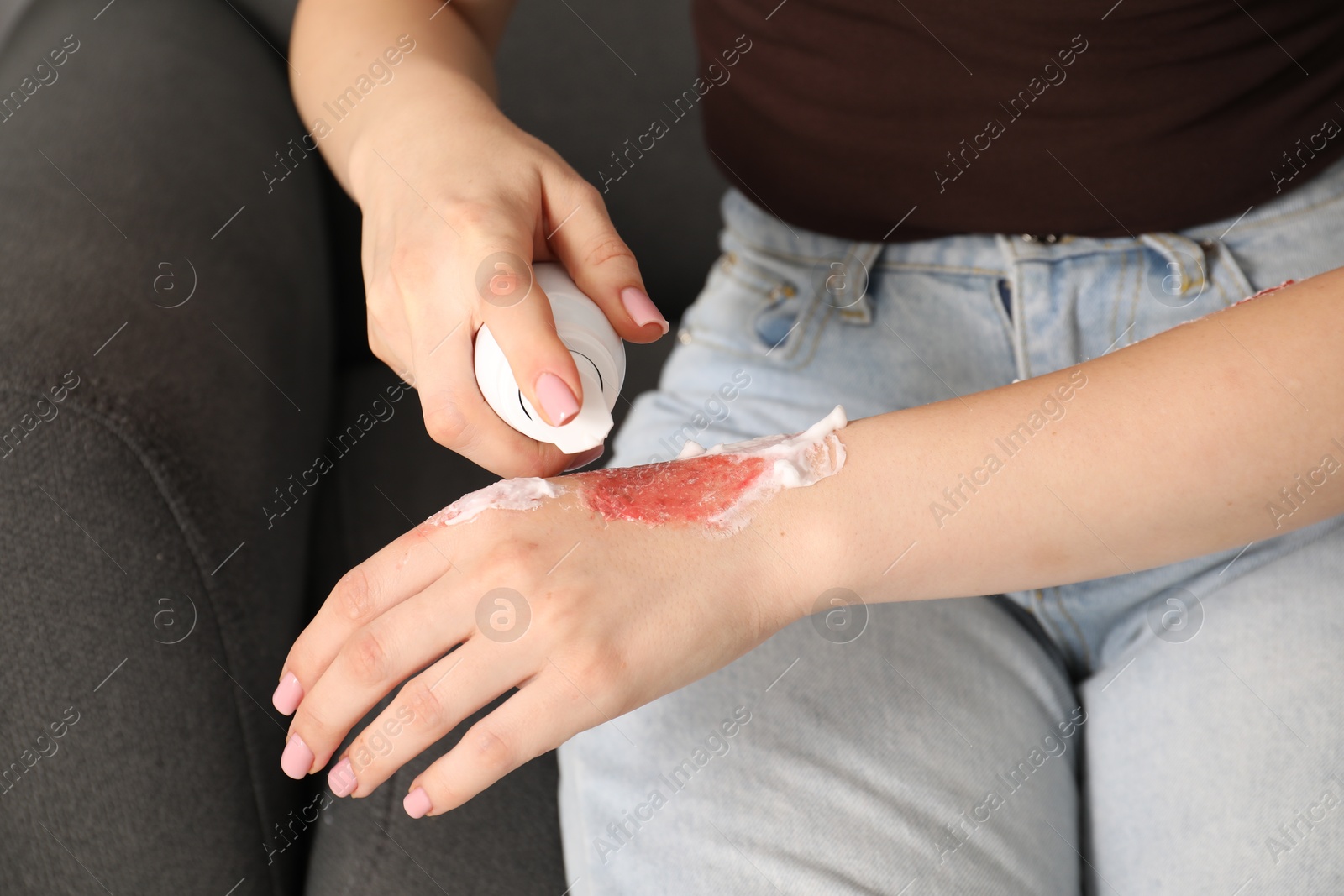 Photo of Woman applying healing cream onto burned hand at home, closeup