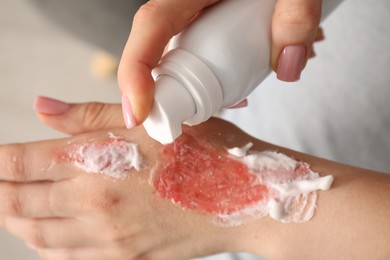 Photo of Woman applying healing cream onto burned hand at home, closeup