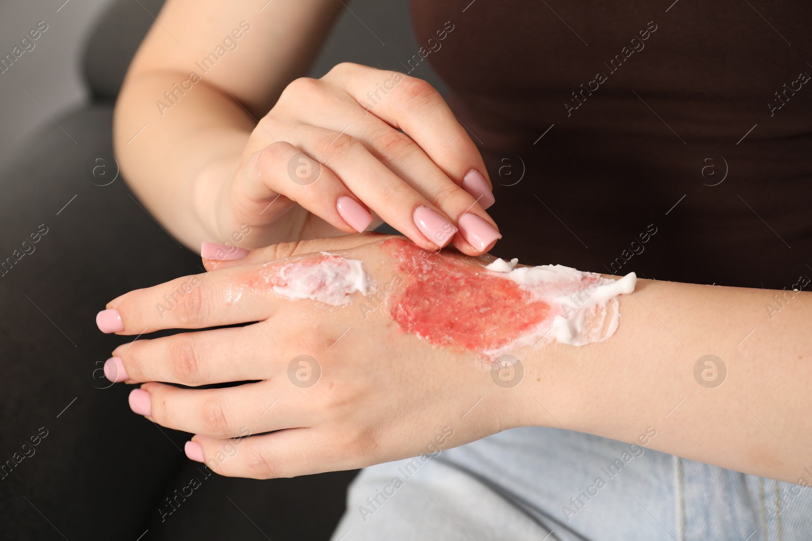 Photo of Woman applying healing cream onto burned hand at home, closeup