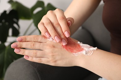 Photo of Woman applying healing cream onto burned hand at home, closeup