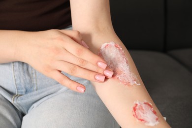 Photo of Woman applying healing cream onto burned hand at home, closeup