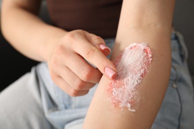 Photo of Woman applying healing cream onto burned hand at home, closeup