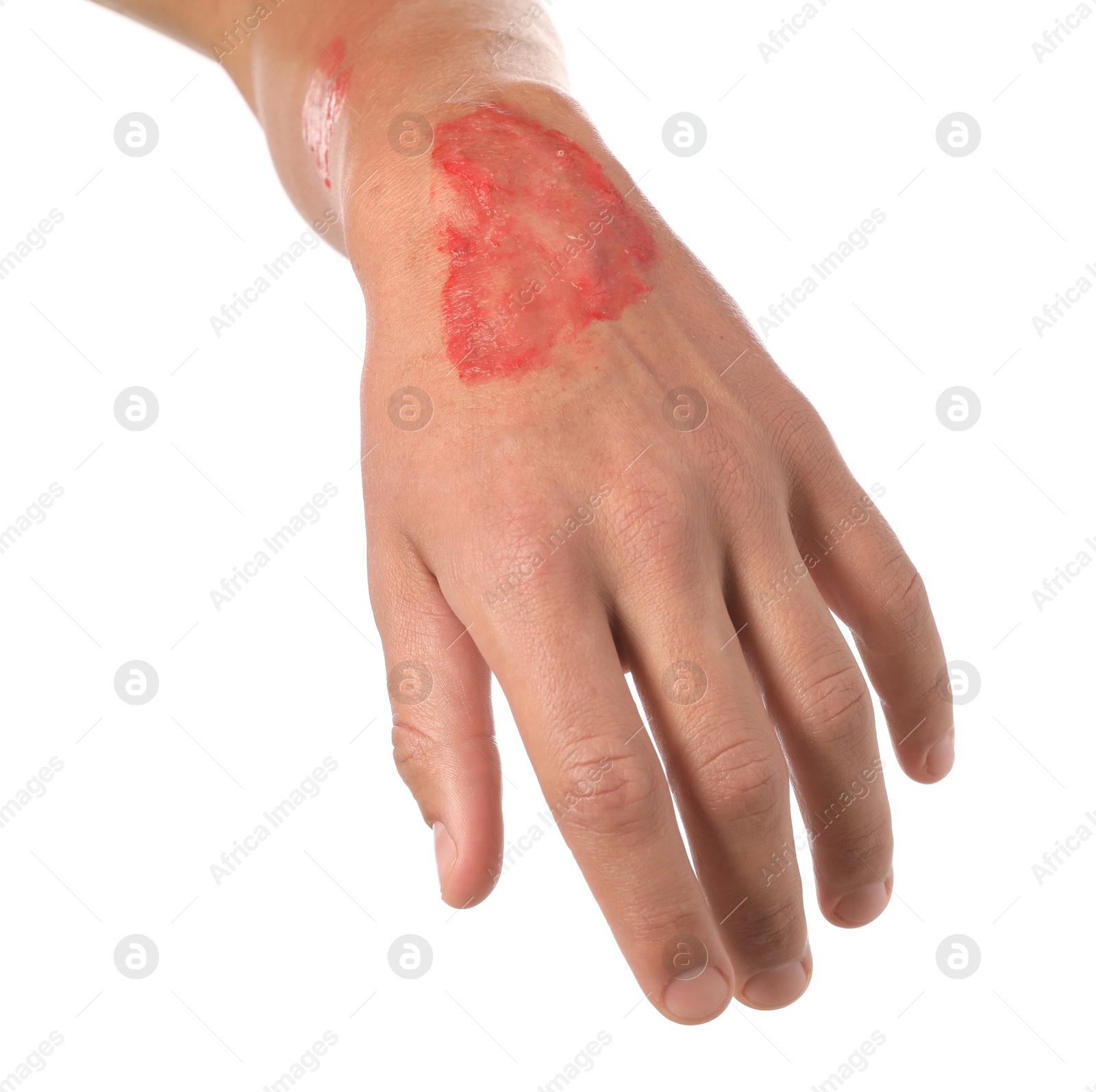 Man with burned hand on white background, closeup Photo of Man with burned hand on white background, closeup