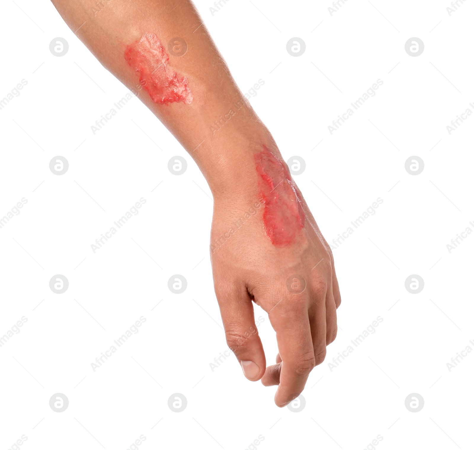 Man with burned hand on white background, closeup Photo of Man with burned hand on white background, closeup
