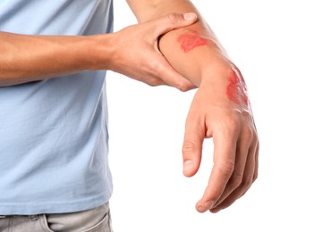 Photo of Man with burned hand on white background, closeup