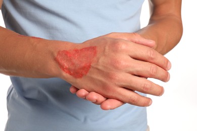 Photo of Man with burned hand on white background, closeup