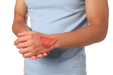 Photo of Man with burned hand on white background, closeup