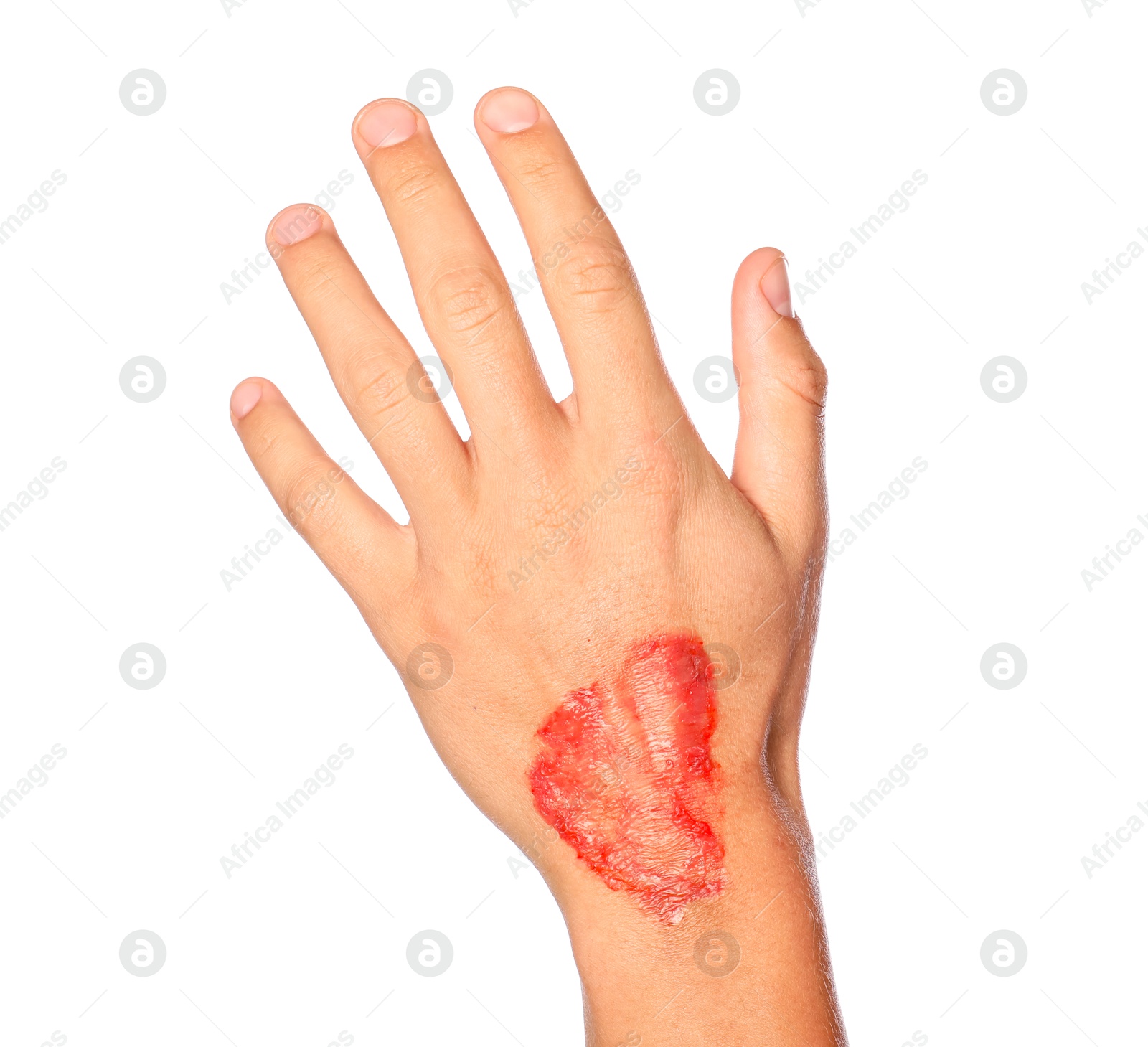 Photo of Man with burned hand on white background, closeup