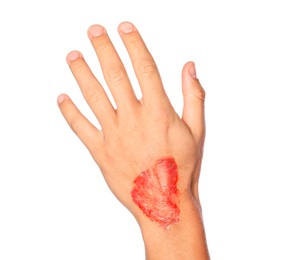 Photo of Man with burned hand on white background, closeup