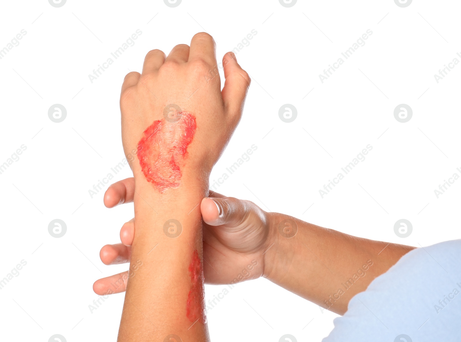 Photo of Man with burned hand on white background, closeup