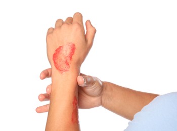 Photo of Man with burned hand on white background, closeup