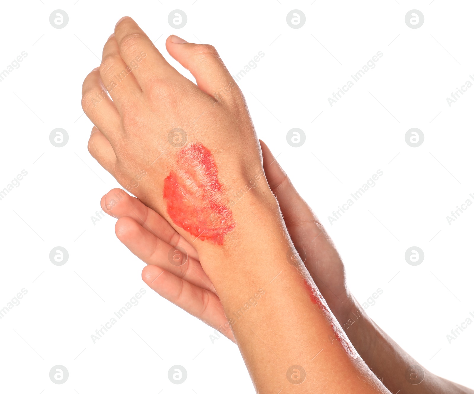 Photo of Man with burned hand on white background, closeup