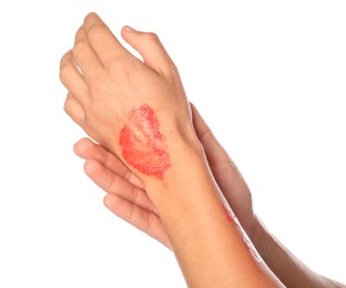 Photo of Man with burned hand on white background, closeup