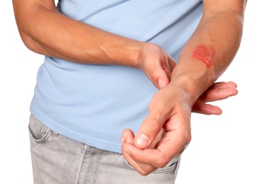 Photo of Man with burned hand on white background, closeup