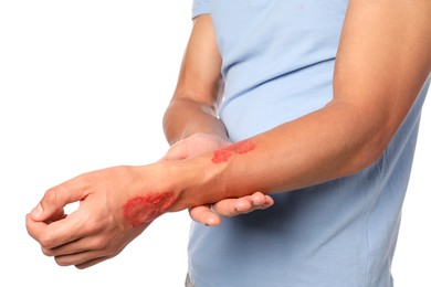 Photo of Man with burned hand on white background, closeup