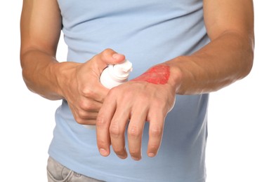Photo of Man applying healing cream onto burned hand on white background, closeup