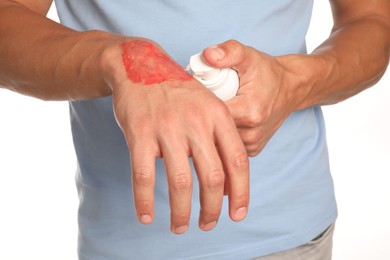 Photo of Man applying healing cream onto burned hand on white background, closeup