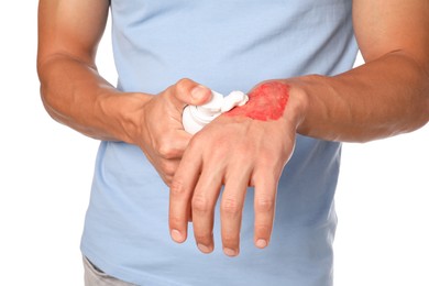 Photo of Man applying healing cream onto burned hand on white background, closeup