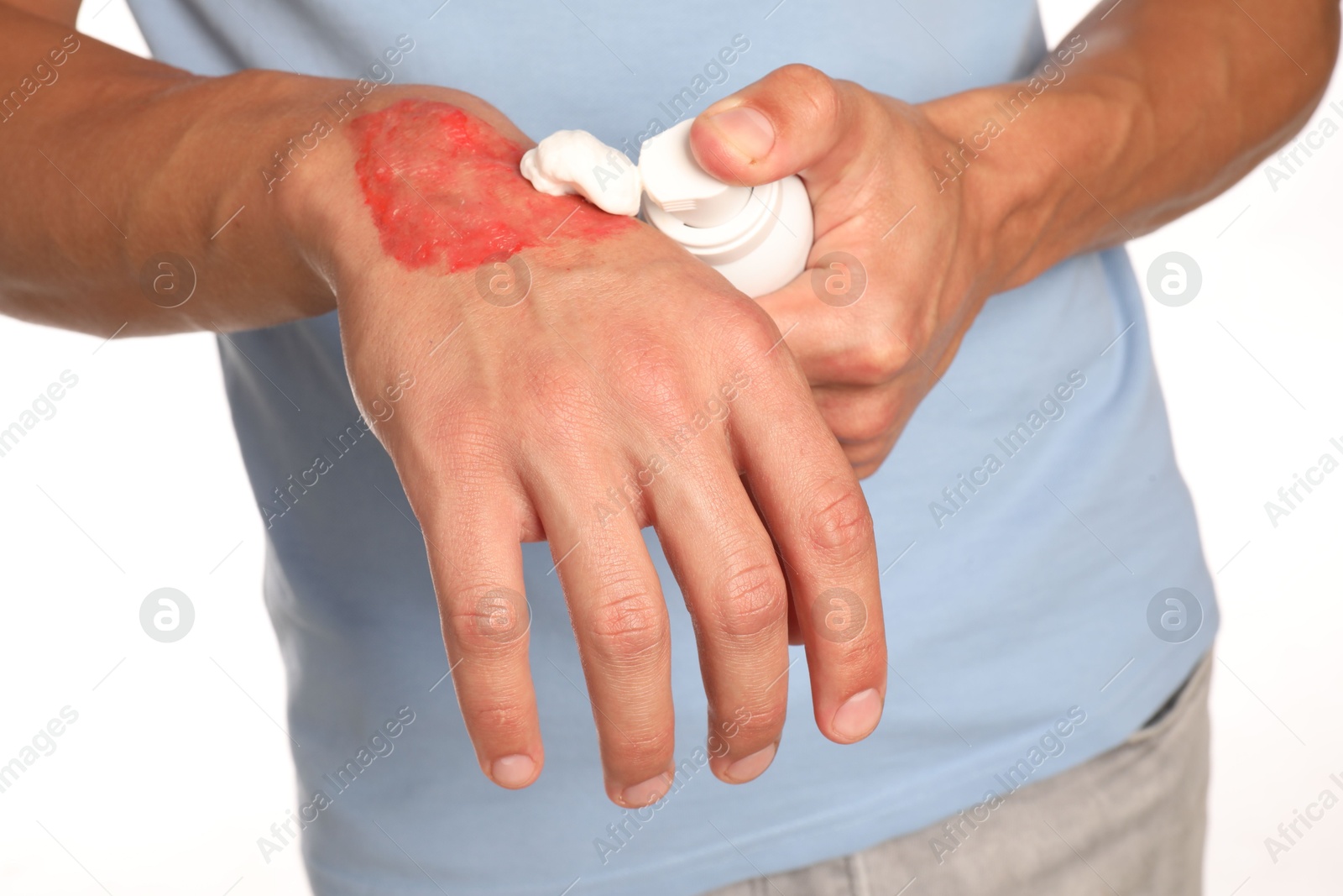 Photo of Man applying healing cream onto burned hand on white background, closeup