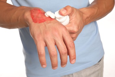 Photo of Man applying healing cream onto burned hand on white background, closeup