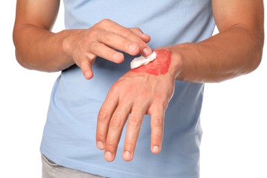 Photo of Man applying healing cream onto burned hand on white background, closeup