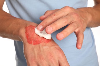 Photo of Man applying healing cream onto burned hand on white background, closeup