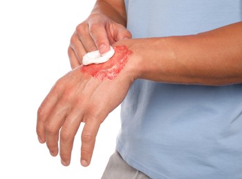 Photo of Man applying healing cream onto burned hand on white background, closeup