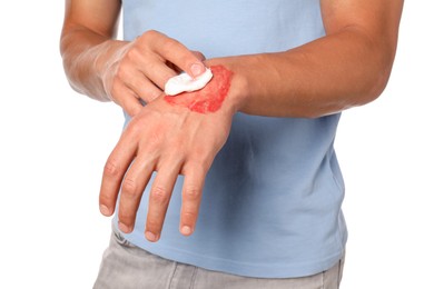 Photo of Man applying healing cream onto burned hand on white background, closeup