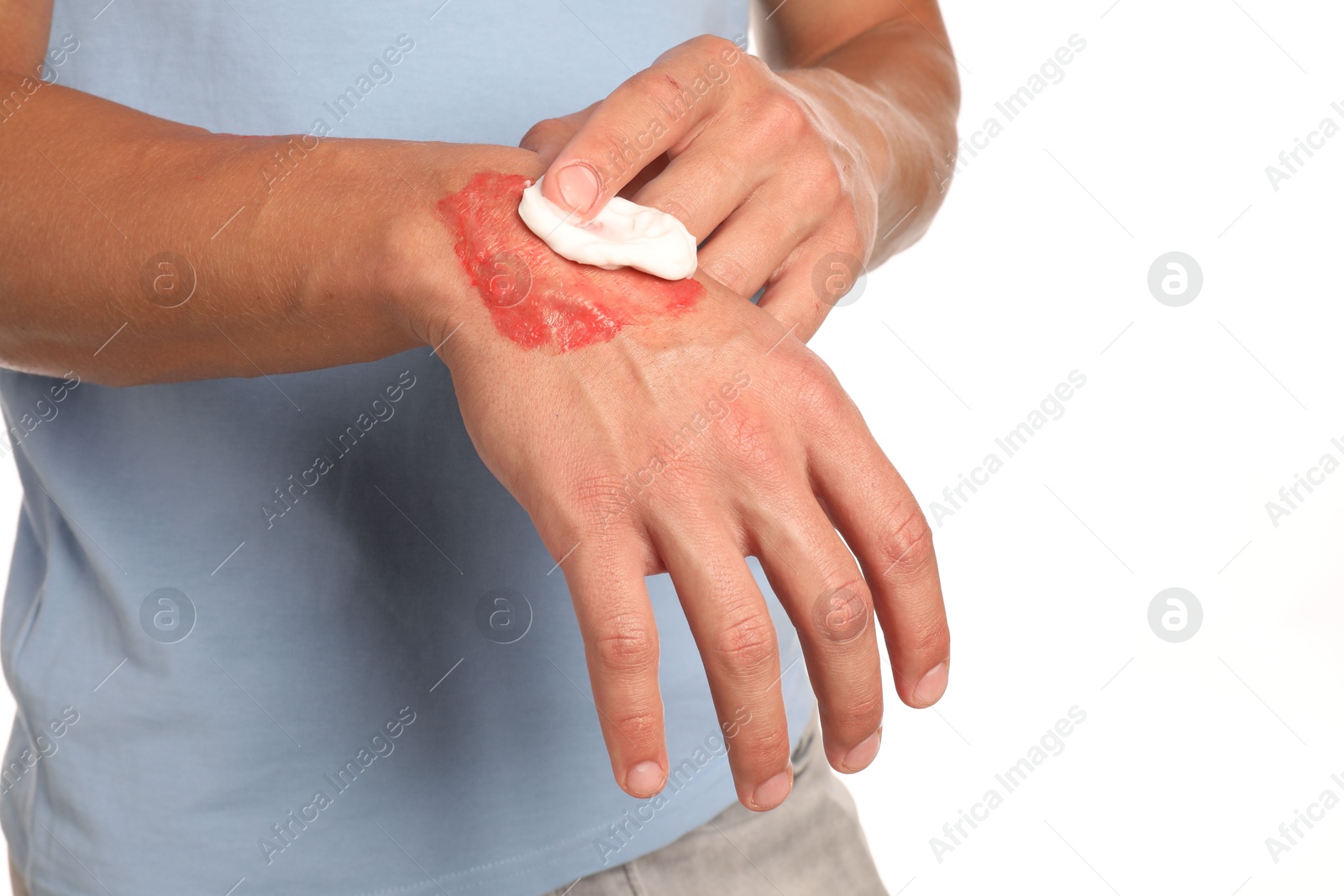 Photo of Man applying healing cream onto burned hand on white background, closeup