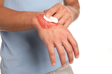 Photo of Man applying healing cream onto burned hand on white background, closeup